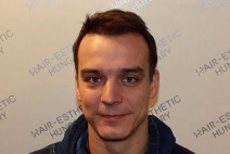 Harsányi Gergely hajbeültetése