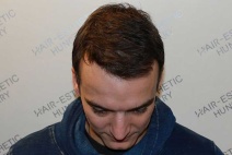 Harsányi Gergely hajbeültetése
