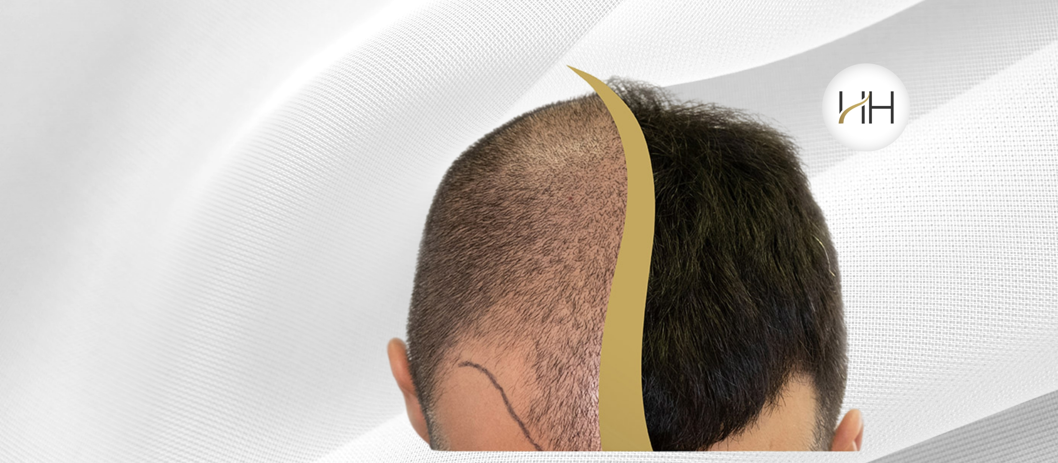 hajbeültetés magabiztosság eredmény 